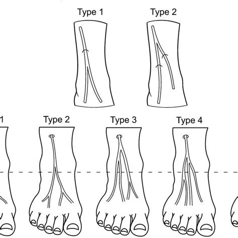 Branching Patterns Of Superficial Fibular Nerve In Relation To The Deep