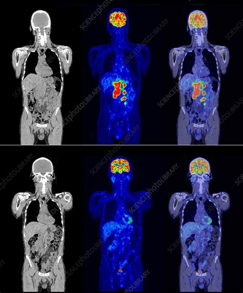 Diffuse Large B Cell Lymphoma Ct And Pet Scan Stock Image C054