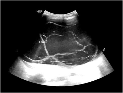 Abdominal Ultrasound Demonstrating A Multilobulated Large Complex Cyst