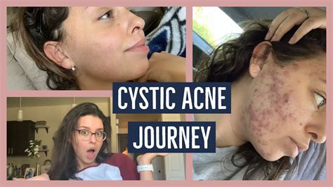 My Cystic Acne Journey Accutane Review Youtube