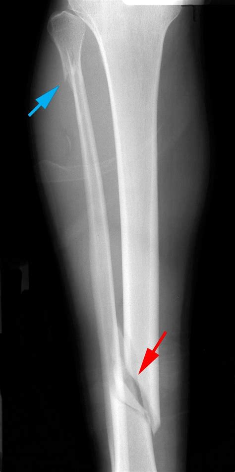 Tibia Hairline Fracture