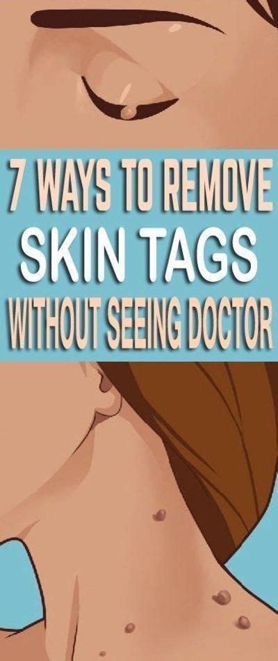 7 easy and homemade ways to remove skin tags without going to a doctor skin tag removal skin