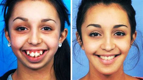 Facial Deformity Correction Vinoda Dental