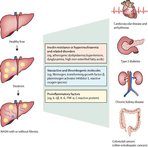 Non Alcoholic Fatty Liver Disease A Multisystem Disease Requiring A