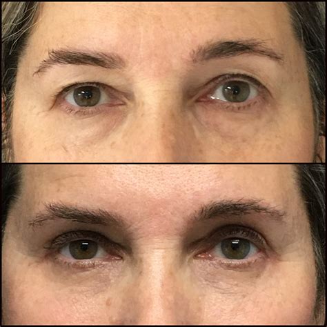 Upper And Lower Blepharoplasty With Fat Transfer Before And After Photos