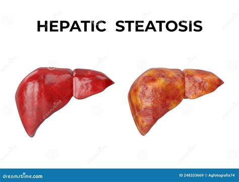 Hepatic Steatosis Is A Disorder Characterized By The Accumulation Of