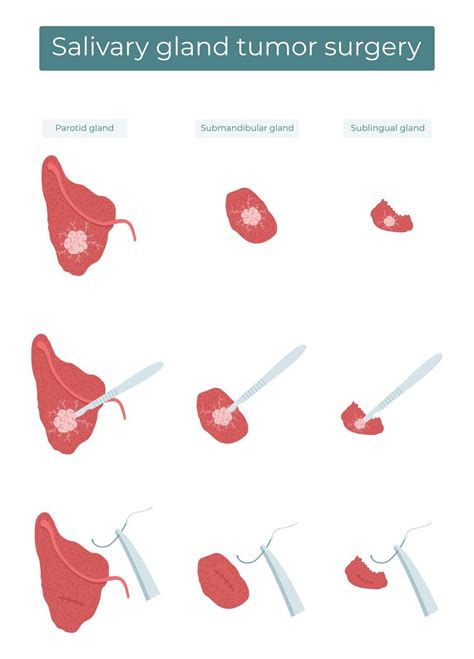 Vector Flat Illustration Of Surgical Removal Of A Tumor From The