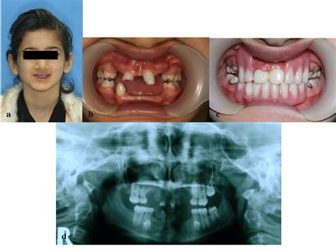 Ectodermal Dysplasia Teeth