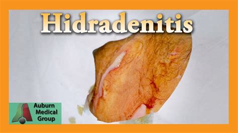 31 Hidradenitis Suppurativa Stage 1 Pictures Insende