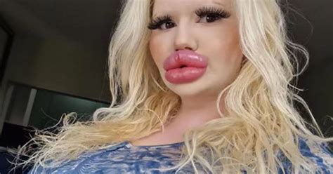 Woman With World S Biggest Lips Undergoes Six Procedures In Just One Day Mirror Online