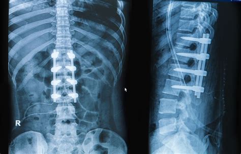 Lumbar Fusion Spinal Fusion Balance And Stability