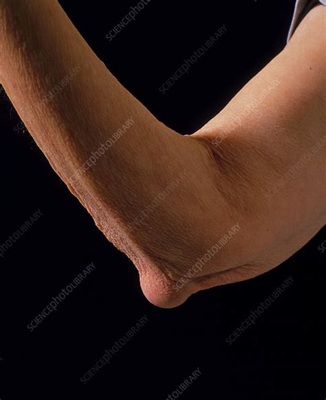 Rheumatoid Arthritis Forming Nodule In The Elbow Stock Image M110