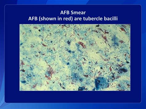 The indirect tests have until recently been regarded as the gold standard of drug susceptibility test. PPT - TUBERCULOSIS PowerPoint Presentation, free download - ID:2325339
