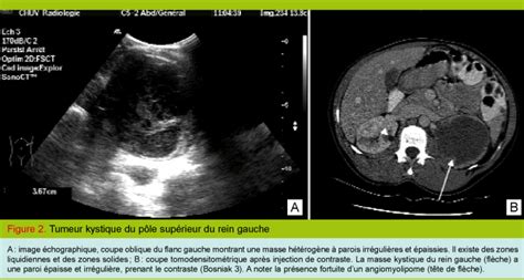 Quelle Attitude Lors De La Découverte De Kystes Rénaux Revue