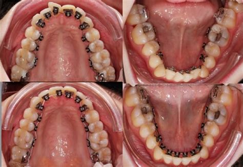 Lingual Orthodontics Lingual Orthodontic Braces Ireland