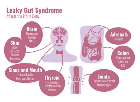 Leaky Gut Syndrome Treatments Caruso Nutrition Therapy And Holistic