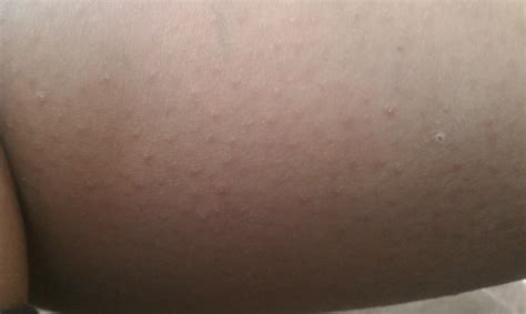 I Have Very Dry Skin Have Been Dealing With It For Over 20