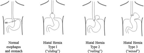 Classification Of Hiatal Hernias Paraesophageal Hernia Open I Cloud