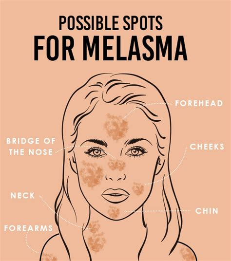 How To Cure Melasma From The Inside Home Remedies Iwqaas