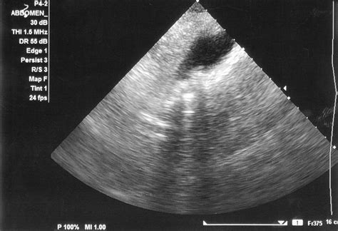 Unlike traditional presentation software, like powerpoint, there's no need to download. 🎖 Gallestein (Cholelithiasis) hos barn