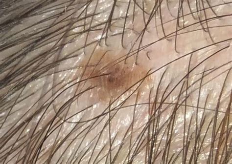 New Mole On Scalp About 5mm Wide Should I Be Worried Rmelanoma