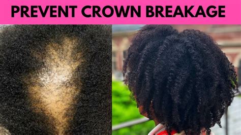 Increase the benefits of your scalp massage by working in a small amount of essential oil. What Causes Sore Scalp? How to Prevent Crown Breakage CCCA ...