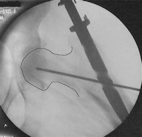 Comparing two intramedullary devices for treating ...