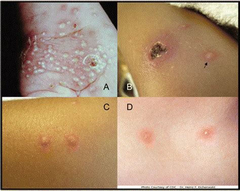 About half of all newborns will develop this and they will usually go away within the first month. A, Photograph of a 6-week-old infant with vesicular ...