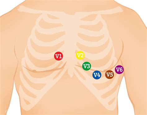 12 Lead Ecg Placement Guide With Illustrations Emt Study