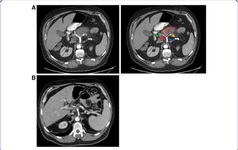 Computed Tomography Scans Of The Patients Abdomen A Before And B