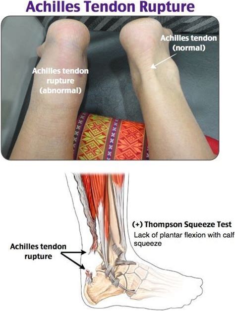 A quadriceps tendon tear is an injury that occurs when the tendon in the front of your thigh tears partially or entirely. Achilles Tendon Rupture Splint | Orthopedic nursing ...