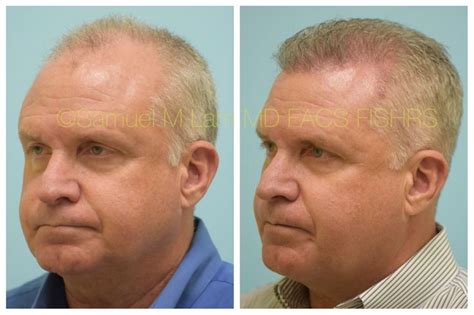 They prescribed neutriderm, curlz vit, elution shampoo. This 60-year-old man is shown before and 6 months after a ...