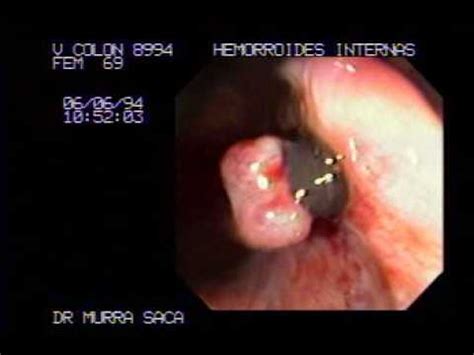 They have many causes and can create symptoms. Internal Hemorrhoids Treatment - YouTube