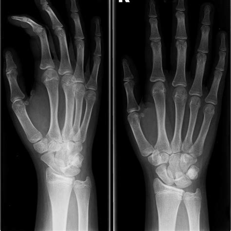 Pdf Delayed Identification Of An Isolated Paediatric Capitate Fracture