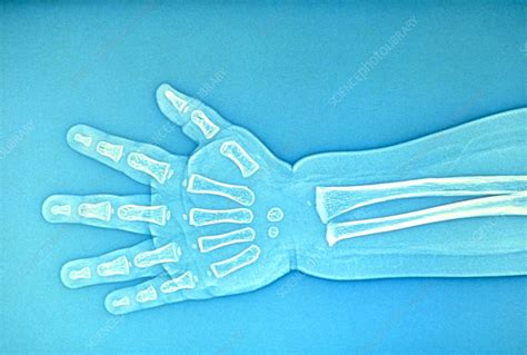 Child Hand X Ray Stock Image P1160429 Science Photo Library