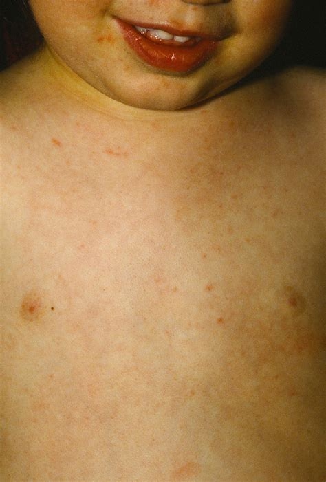 Roseola Causes Roseola Infantum Symptoms Rash Treatment