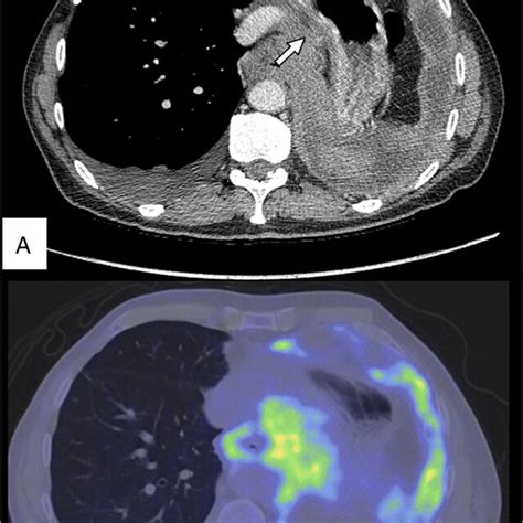 A Positron Emission Tomography Computed Tomography Pet Ct Showing
