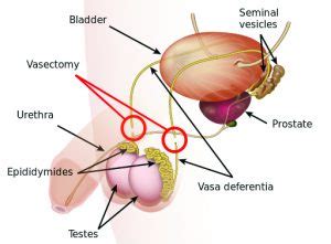 You may be able to get your vasectomy for free or at a low cost. Vasectomy - The Procedure Step-By-Step - Tennessee Urology
