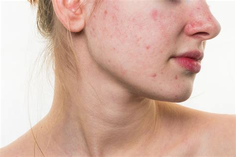 How To Treat Acne And Dry Skin At The Same Time By The Skin Expert The London Skin Clinic