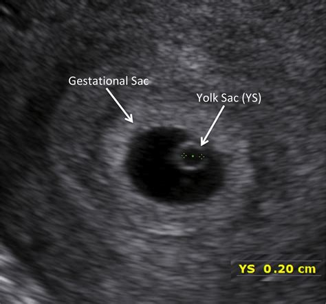 Egg Yolk Ultrasound at Steve Eldridge blog