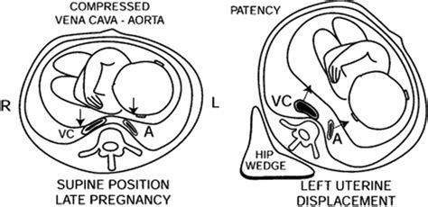 Percutaneous Approach To A Complicated Case Of Nephrolithiasis In A