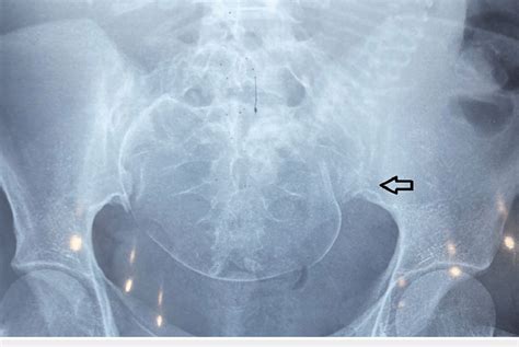 X Ray Bilateral Sacroiliac View Showing Left Sided Sacroiliitis With