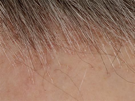 Lichen Planopilaris Frontal Fibrosing Alopecia En Lassueur Graham My