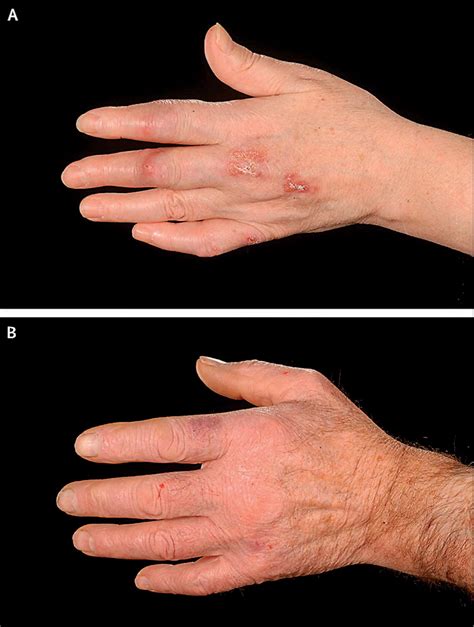 A Husband And Wife With Left Hand Rashes The Lancet Infectious Diseases