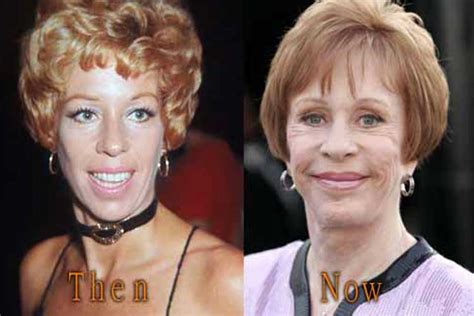 Carol Burnett Plastic Surgery Facelift Botox Before And After Photos