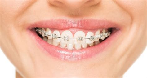 Will braces help my severe tmj? Dental Braces And Pediatric Dentistry: Everything You Need ...