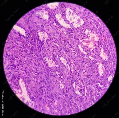 Naklejka Tissue From Ring Finger Neurofibroma A Type Of Benign Tumor
