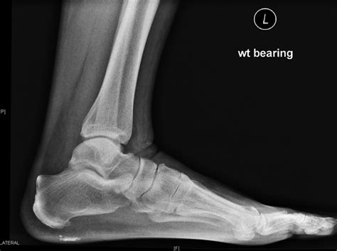 Plantar Fascia Calcification A Sequelae Of Corticosteroid Injection In