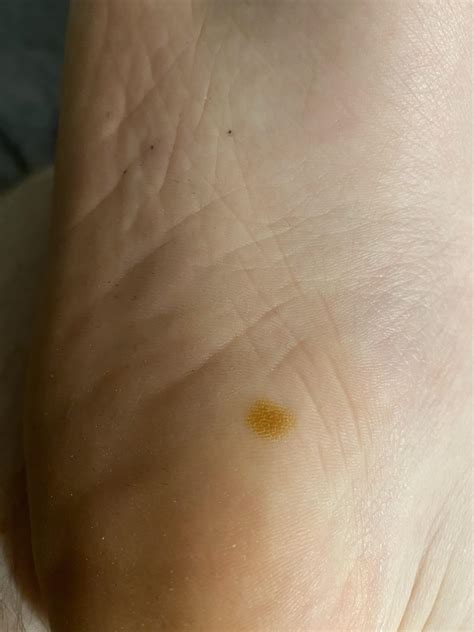 Whats This Brown Spot On The Bottom Of My Foot Rmedical