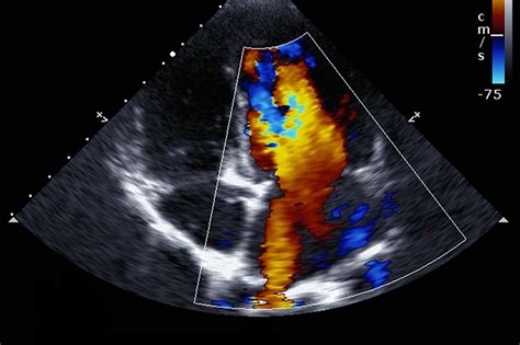 Check spelling or type a new query. Having an Echocardiogram: What You Need to Know | UPMC ...